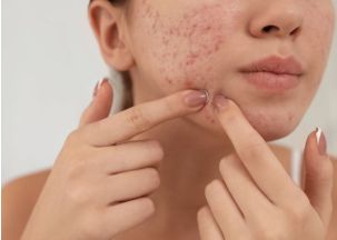 Acné en Martinique : quelle routine adopter face à la chaleur et à l’humidité ?