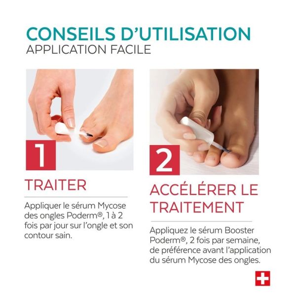 Duo express - Mycose des ongles